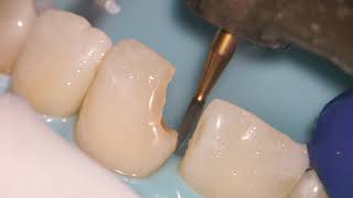 Teeth Bonding  Front tooth filling EXPLAINED [upl. by Ahseei]