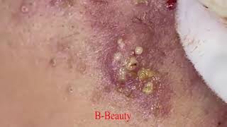 Pimple Removal and Acnes Treatment  BBeauty 07 [upl. by Ayaros]