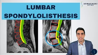 Lumbar Spondylolisthesis  Anatomy Symptoms Causes Treatments and more [upl. by Ris]