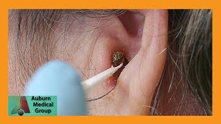 Chunky Earwax Removal  Auburn Medical Group [upl. by Assyn]