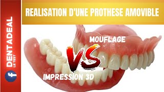 Prothèse Amovible Dentaire  IMPRESSION 3D VS MOUFLAGE [upl. by Yelrac]