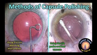 capsule polishing methods in cataract surgery [upl. by Rasec]