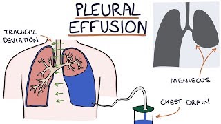 Understanding Pleural Effusions [upl. by Aurilia564]