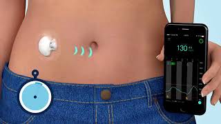 What is Continuous Glucose Monitoring CGM [upl. by Lladnek]