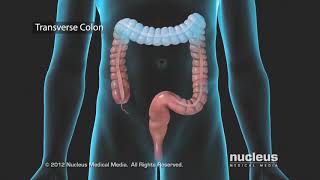 Colon Problems Diverticular Disease [upl. by Cummine986]