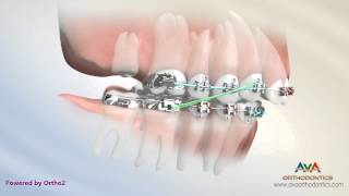 Orthodontic Treatment for Overbite Overjet  Removing Second Molar [upl. by Yenitirb479]