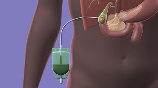 Acute Cholecystitis and Cholangitis [upl. by Airotal]