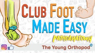 CLUB FOOT Pathoanatomy Made Easy  The Young Orthopod [upl. by Leunas337]