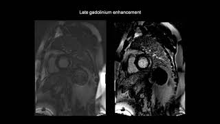 How to assess myocarditis with the help of cardiac MRI CMR [upl. by Hambley]