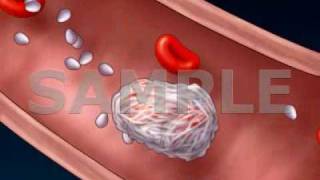 Clot Formation and Clot Breakdown 2D Medical Animation [upl. by Levitus973]