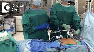 How long does it take to recover from Laparoscopic Surgery  Dr Beena Jeysingh [upl. by Aciraa414]