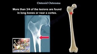 Osteoid Osteoma  Everything You Need To Know  Dr Nabil Ebraheim [upl. by Ruhtua]