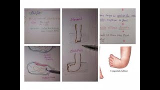 CLUB FOOT  TALIPES EQUINOVARUS Chlid Health Nursing  INTRODUCTION AND PATHOPHYSIOLOGY [upl. by Ardnassak]