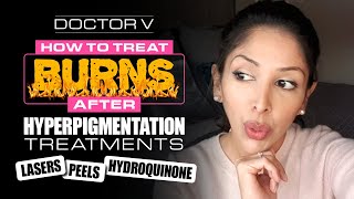 Doctor V  How To Treat Burns after Hyperpigmentation Treatments  Skin of Colour [upl. by Staffan614]