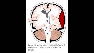 Herniation Syndromes  Cingulate subfalcine Transtentorial Uncal amp Cerebellar Tonsillar [upl. by Irol]