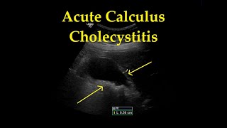 Gallstones  Cholelithiasis Symptoms Causes Diagnosis and Treatment [upl. by Samy]