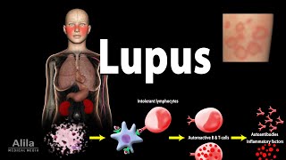 Understanding Lupus Causes and Risk Factors [upl. by Nodal]