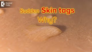 Why do I suddenly have skin tags Are they dangerous  Dr Rasya Dixit [upl. by Robins]