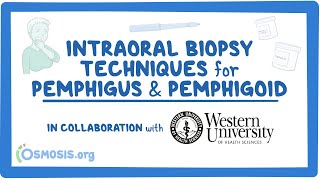 Intraoral Biopsy Techniques for Pemphigus amp Pemphigoid in Collaboration w Western University [upl. by Annaed]