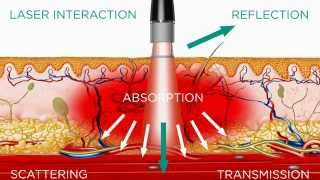 High Intensity Laser  Medical Effects [upl. by Necaj41]