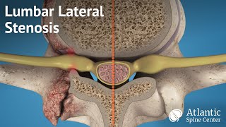 Lumbar Lateral Stenosis [upl. by Zwart]