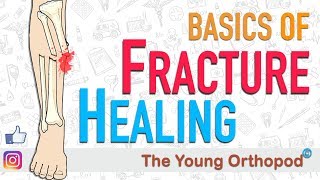 Fracture Healing  ANIMATION  BASICS  The Young Orthopod [upl. by Launcelot599]