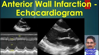 Anterior Wall Infarction Echocardiogram [upl. by Yeo810]