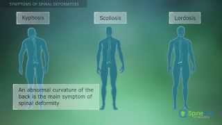 Spinal Deformities Symptoms [upl. by Ayota999]