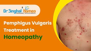 Best Homeopathic Treatment for Pemphigus Vulgaris  Dr Singhal Homeo [upl. by Anerev215]