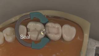 Class II Composite Restoration  Stevenson Dental Solutions [upl. by Ronile]