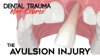 Dental Trauma MiniCourse  Part 12  Dental Trauma Guide  The Avulsion Dental Injury [upl. by Kistner]