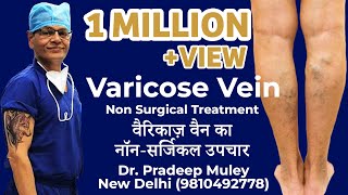 Varicose vein treatment procedure MicrowaveRFALaser Ablation Surgery [upl. by Bettzel387]