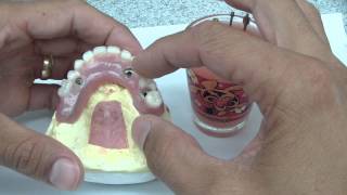 Overdenture Abutment Part 1 [upl. by Kale349]