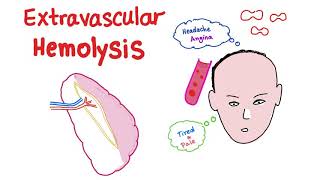 Extravascular Hemolysis [upl. by Fulvia]