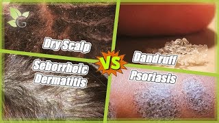 Dry Scalp vs Dandruff vs Seborrheic Dermatitis vs Psoriasis [upl. by Cleave]