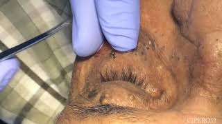 Milia  Stringoma Removal  Periorbital Area [upl. by Ttekcirc]