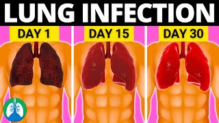 Top 10 Natural Lung Infection Treatments Home Remedies [upl. by Inotna]