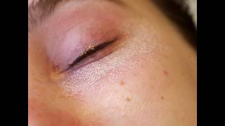 Lower Eyelid Surgery Suzannes Recovery amp Results [upl. by Ierna]