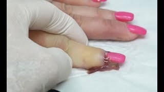 Worst Nail Infections of All Time Paronychia [upl. by Kakalina]