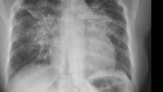 Chest xray Pneumocystis carinii pneumonia lamellar effusion [upl. by Kaliski]