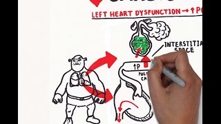 Pulmonary edema USMLE step 1 [upl. by Filahk792]