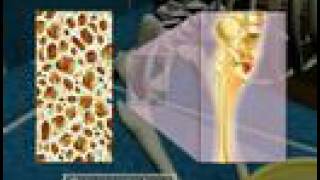 Osteoporosis3D Medical Animation [upl. by Sacrod]