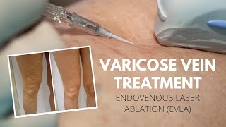 Endovenous Laser Ablation to treat Varicose Veins  Vein Health Vein Clinic [upl. by Lamont463]