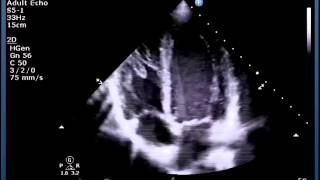 How to obtain CRAB VIEW Paediatric Echocardiography [upl. by Tarrance]