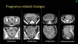 Gynecologic Radiology Anatomy [upl. by Akessej]