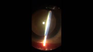 Nuclear sclerosis with Posterior subcapsular cataract [upl. by Ettelohcin]