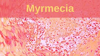 Deep Palmoplantar Wart Myrmecia  Pathology mini tutorial [upl. by Masson]