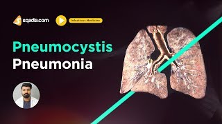 Pneumocystis Pneumonia  Infectious Medicine Lectures  Medical Education  VLearning [upl. by Carrissa]