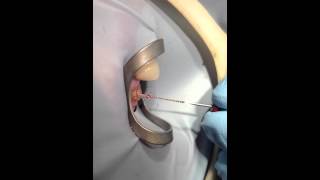 Dental Tooth Nerve removed live from Patient [upl. by Neiv]