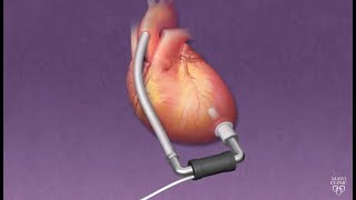 Mayo Clinic Minute How ventricular assist devices can help heart patients [upl. by Femi]